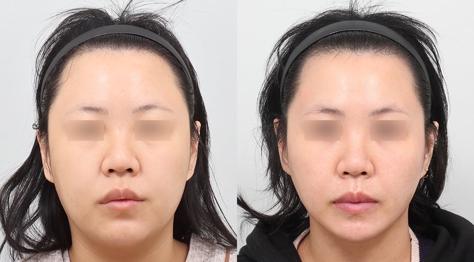 หน้าเรียวแบบธรรมชาติ เกาหลี