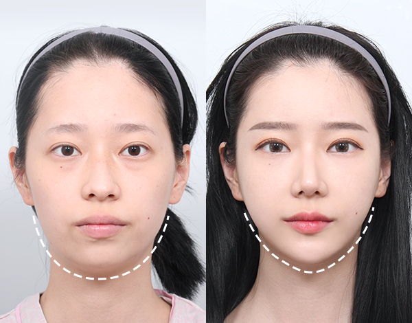 ศัลยกรรมหน้าเด็กเกาหลี