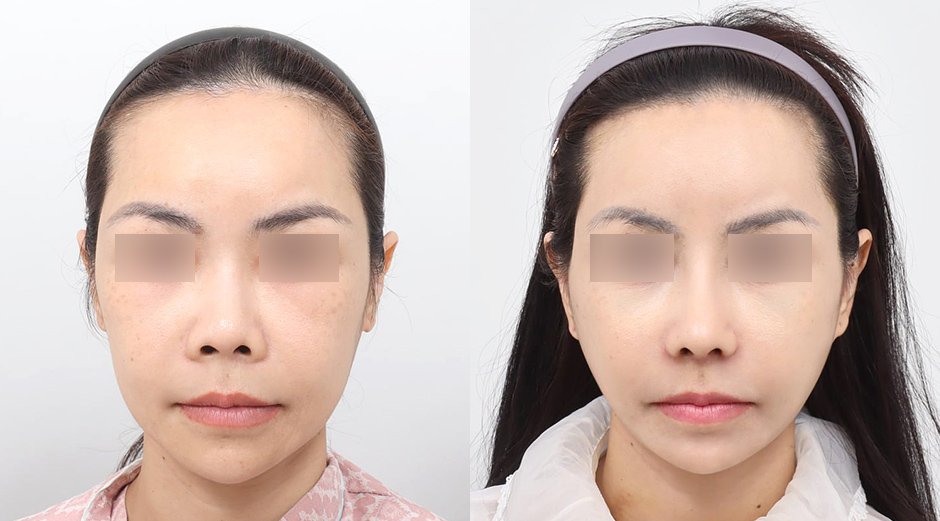 แพ็กเกจศัลยกรรมสุดคุ้ม