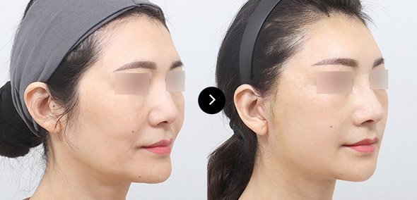 หน้าเรียวแบบธรรมชาติ เกาหลี