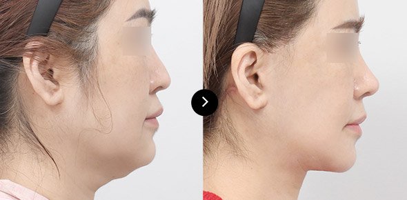 บล็อกศัลยกรรมเกาหลี